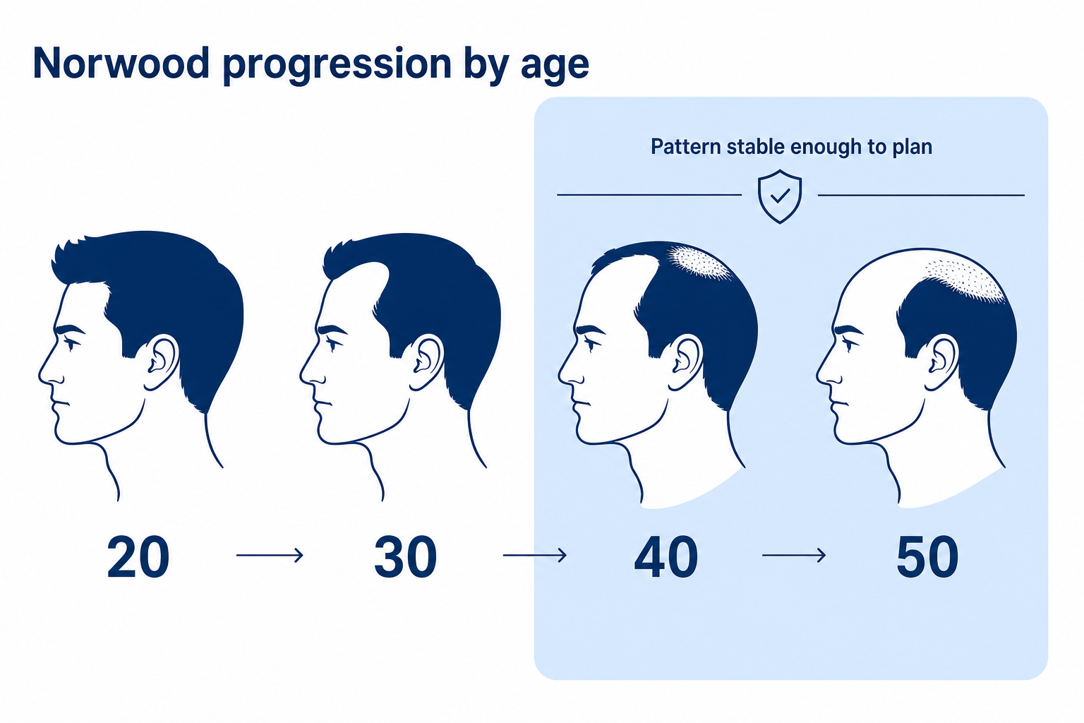 Timeline of Norwood progression: hair loss advancing with increasing age