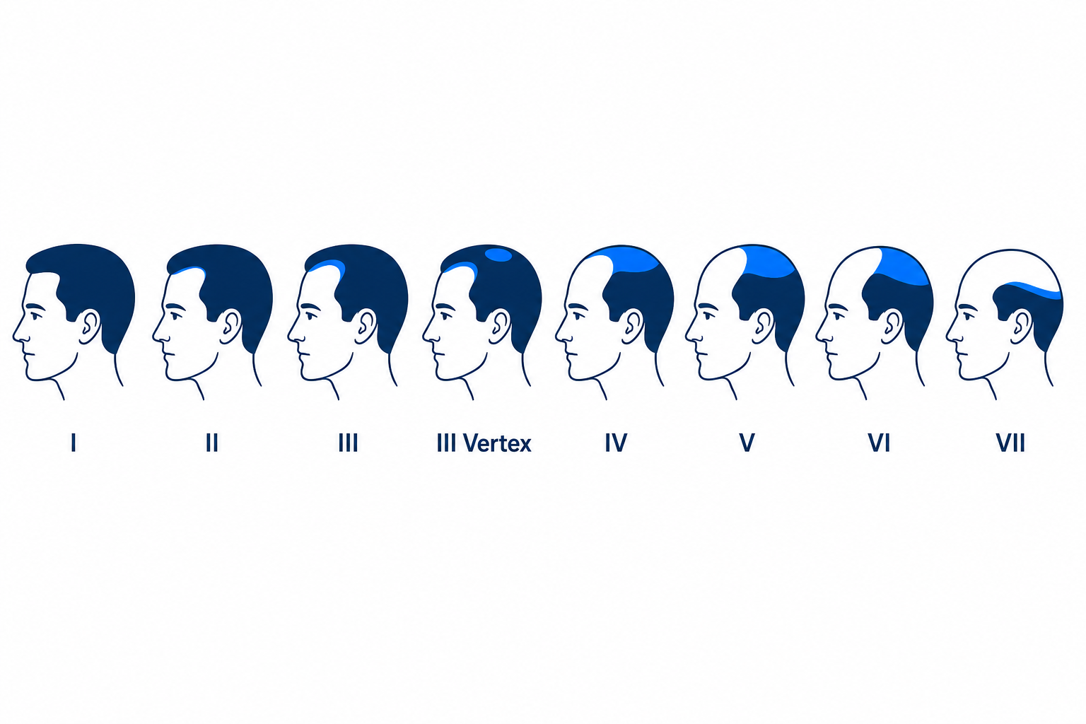 Hamilton-Norwood scale from stage I to VII with a progressively receding hairline