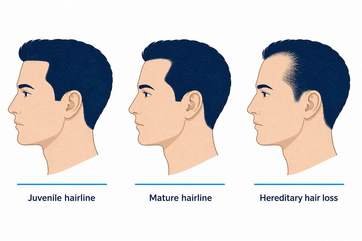 Three head profiles compared: juvenile hairline, mature hairline and hereditary hair loss