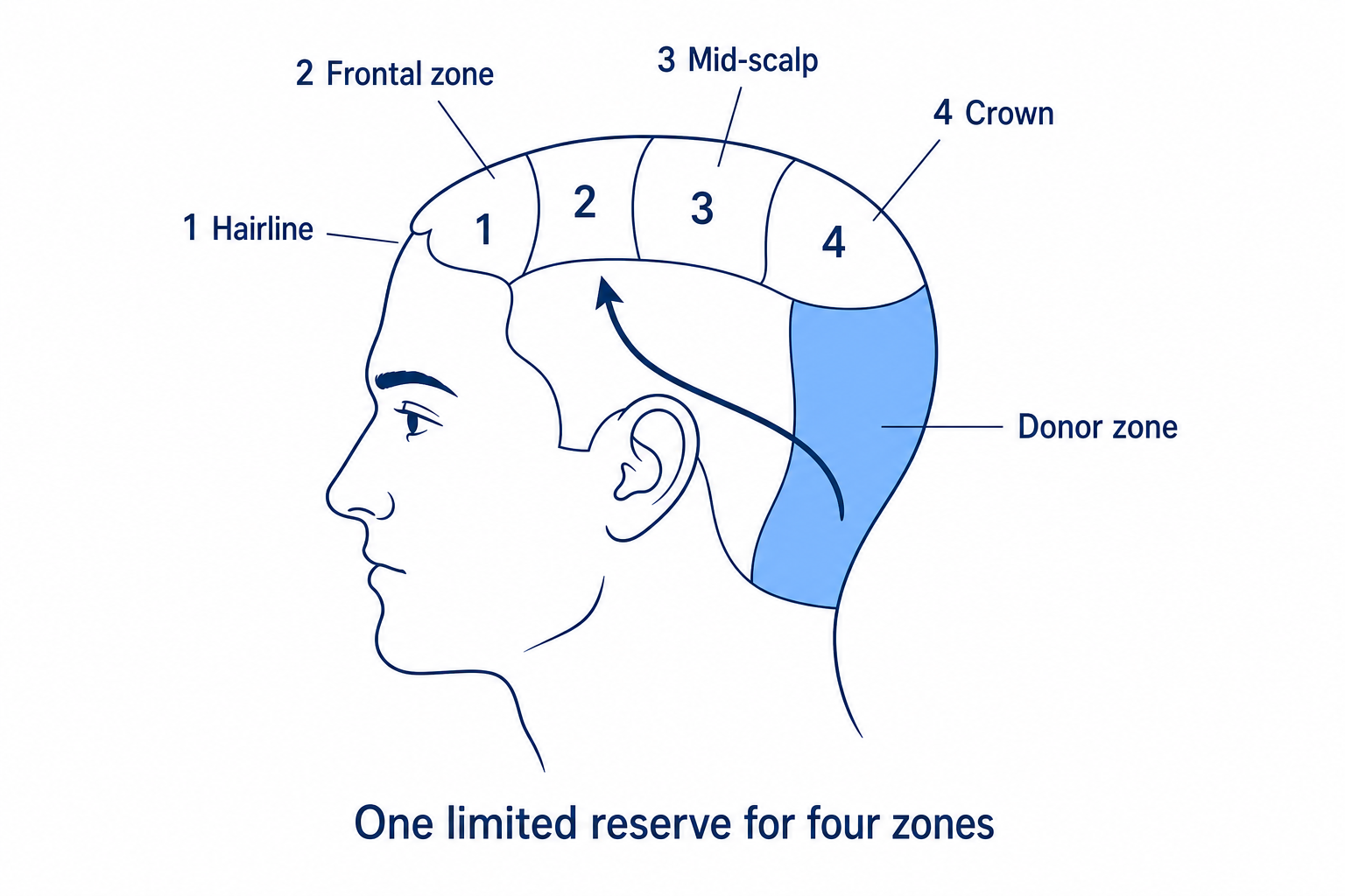 Diagram: the limited donor zone at the back of the head supplies four numbered recipient zones from the hairline to the crown