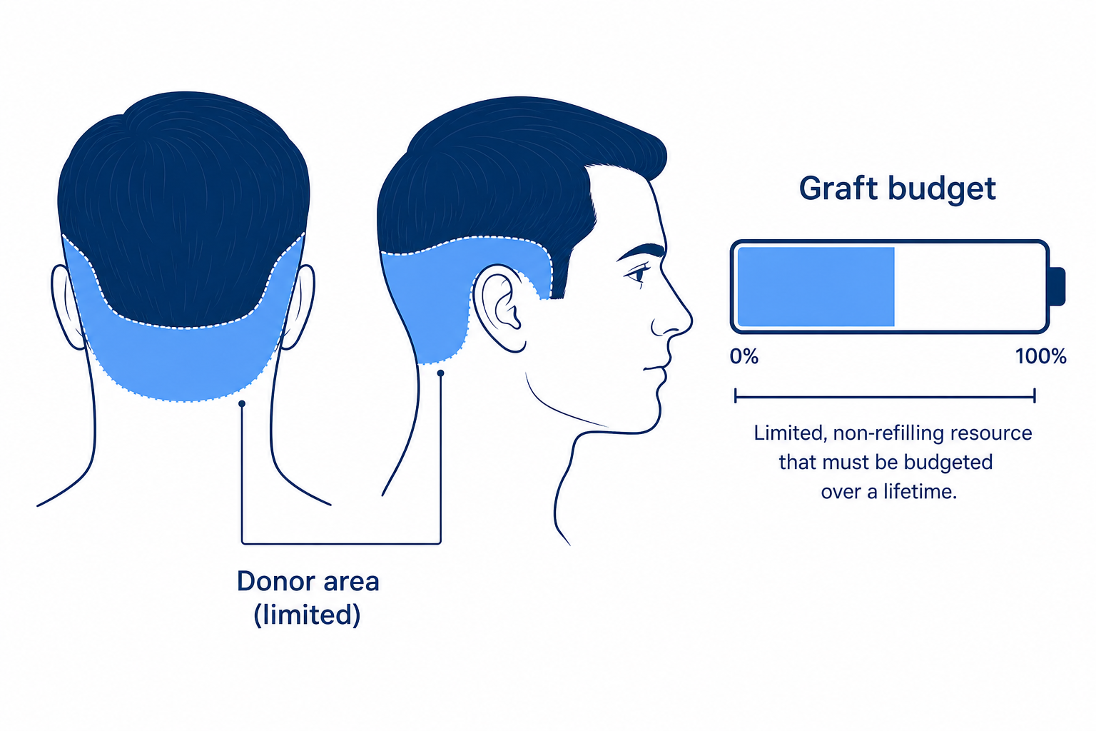 Diagram of the limited donor area at the back of the head as a lifetime graft budget