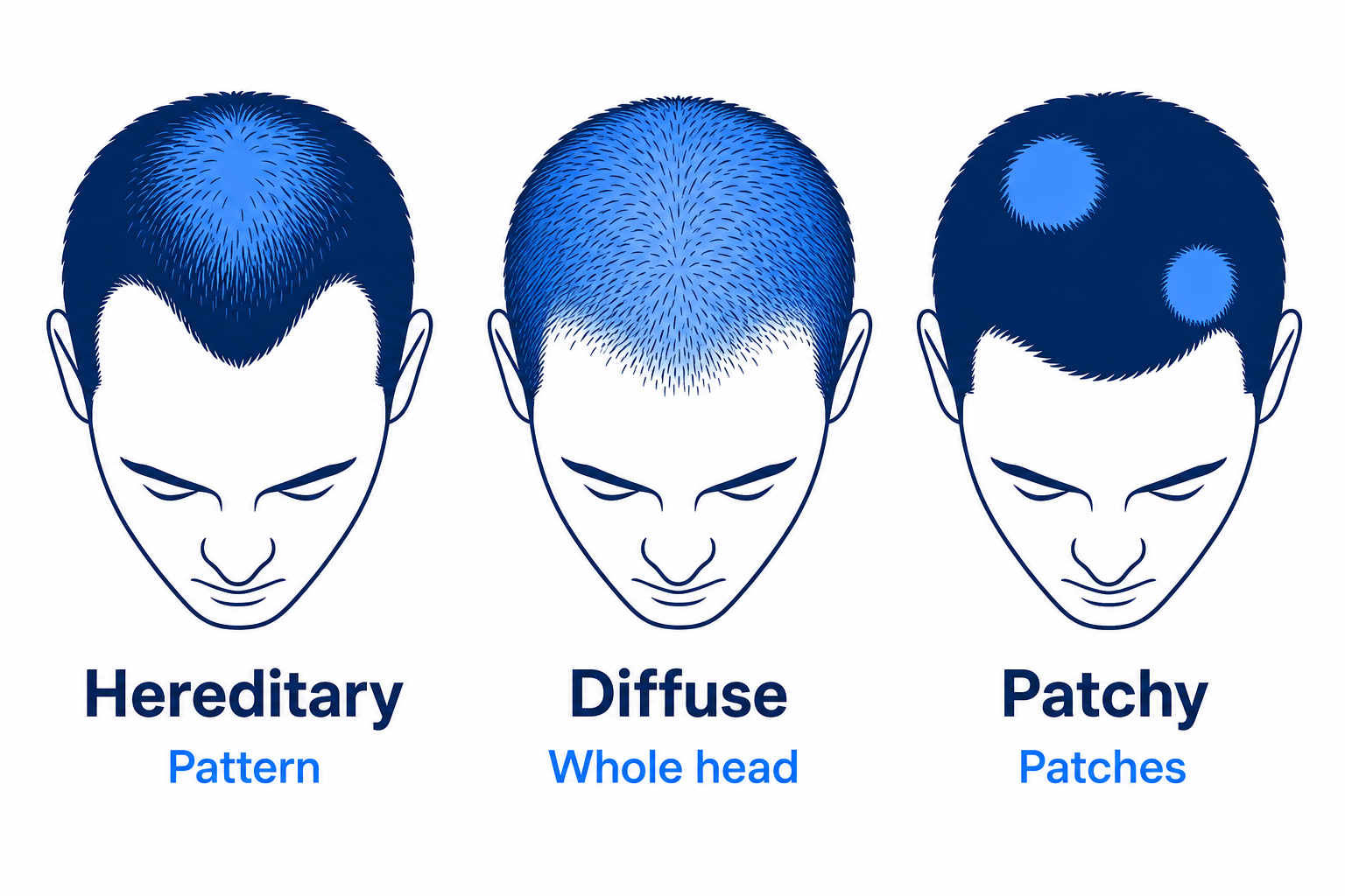 Infographic of the three types of hair loss: hereditary, diffuse and patchy
