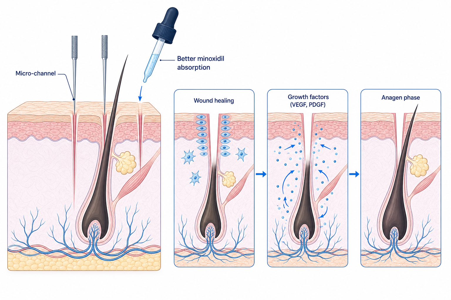 Illustration of how microneedling works on the scalp: micro-channel, wound healing, growth factors and the anagen phase