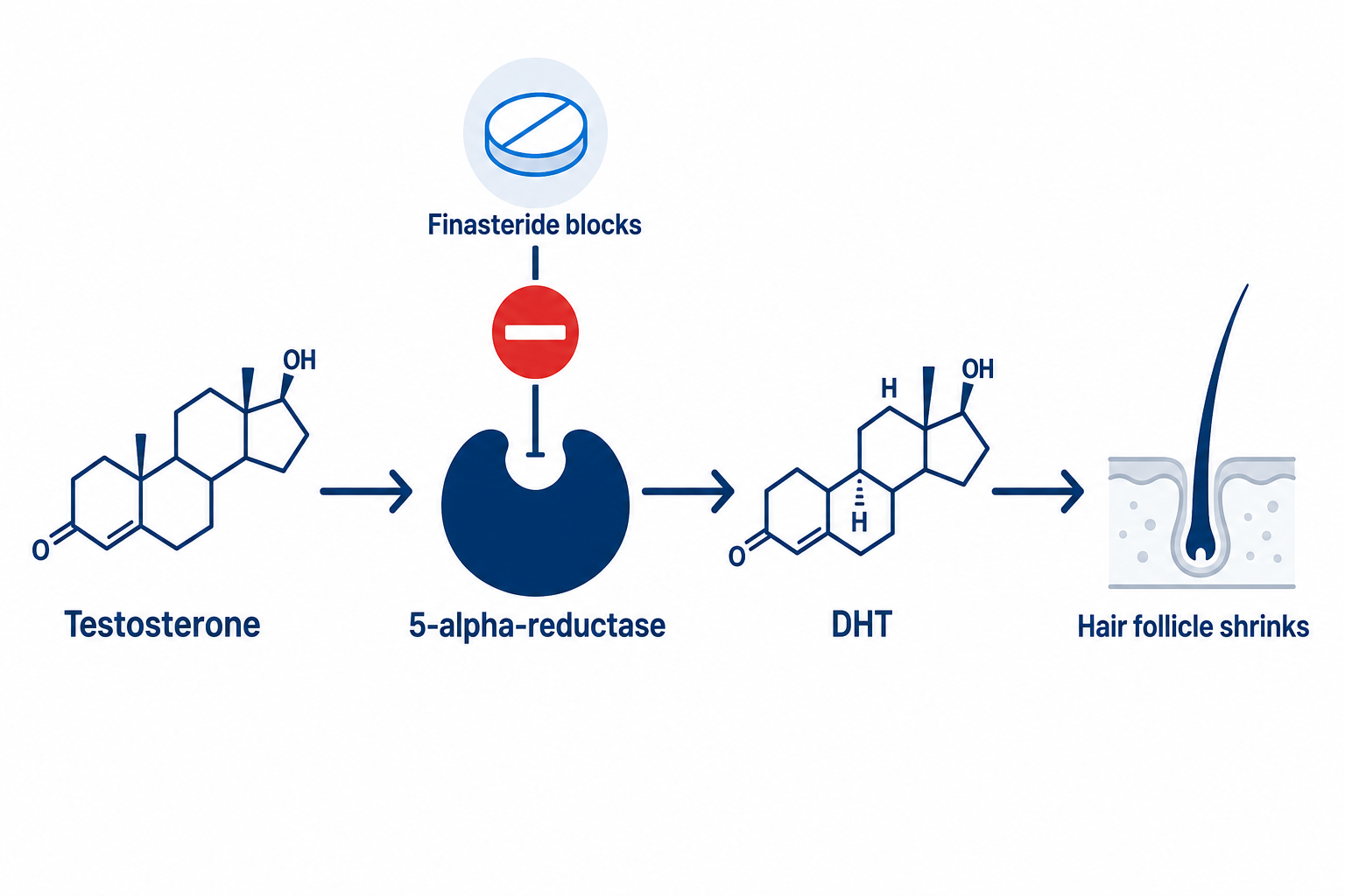 Diagram of how finasteride works: finasteride blocks 5-alpha-reductase and lowers DHT