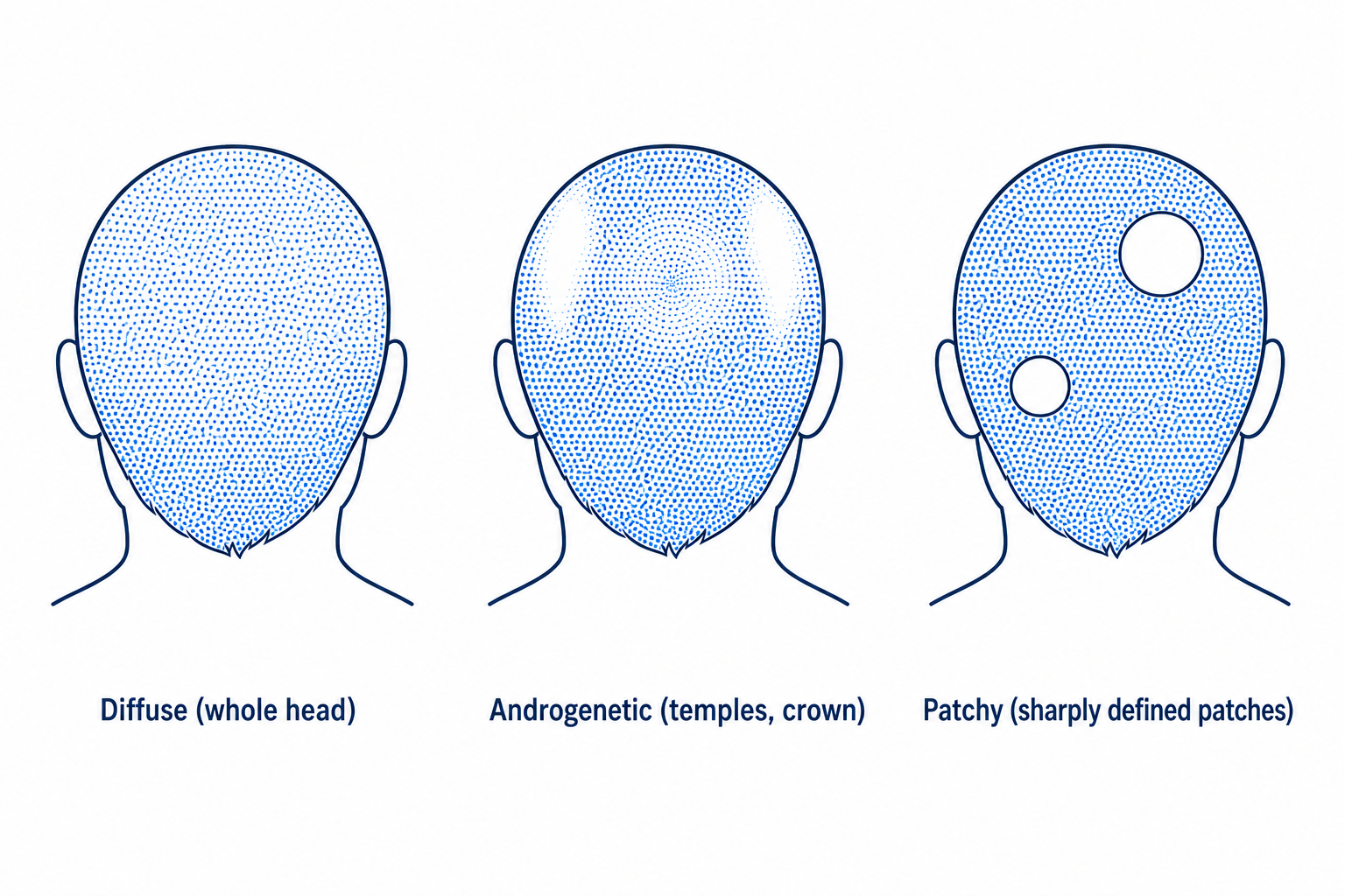 Comparison of the three loss patterns: diffuse, androgenetic, and patchy, shown as head silhouettes