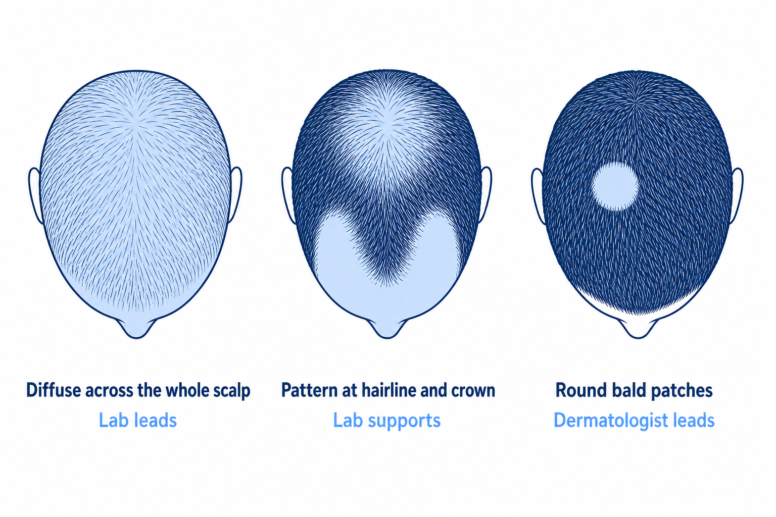 Three hair loss patterns seen from above: diffuse, a pattern at the hairline and crown, round bald patches
