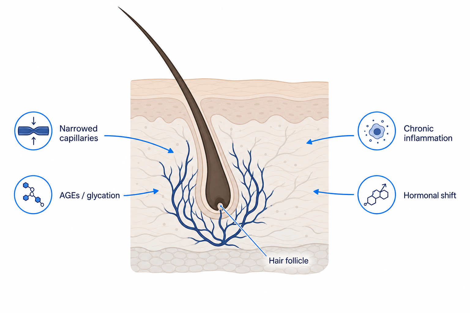 Illustration of a hair follicle in a cross-section of the skin with the four mechanisms by which diabetes disrupts hair growth