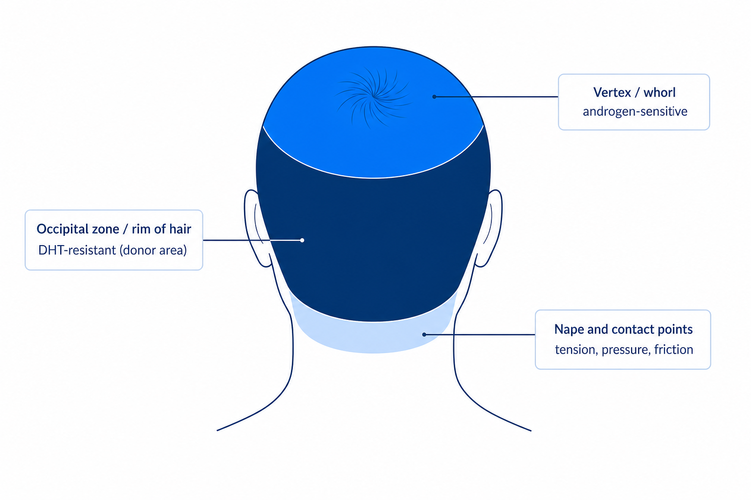 Zones of the back of the head: vertex with whorl, occipital donor area and nape with their typical causes