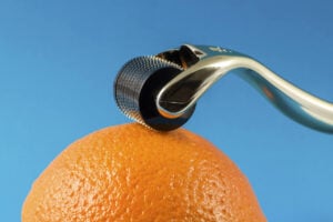 the dermaroller is the most an essential tool for microneedling but does it really work
