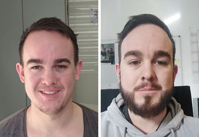 Before after Sapphire Beard transplantation with 4300 Grafts for Patient Oliver N
