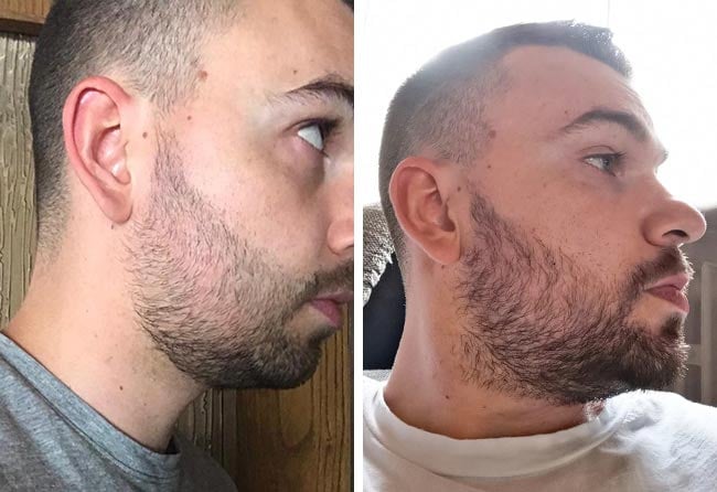 image after beard implant sapphire 2700 grafts 3 months nico mueller