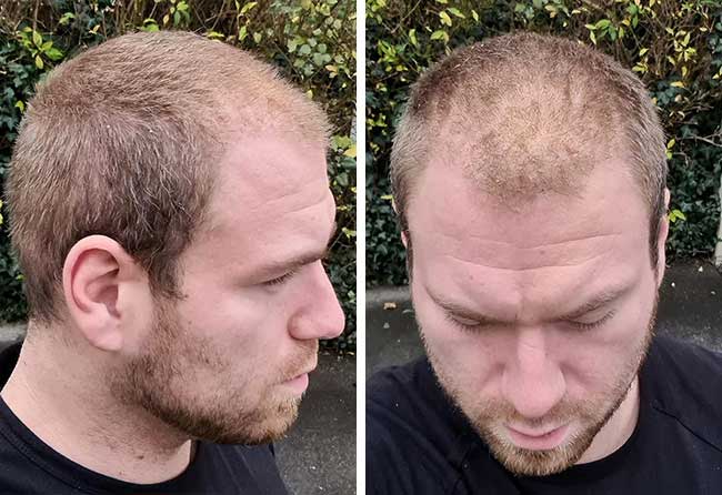 Image after hair transplant 1 month 4500 grafts kewin lenzing
