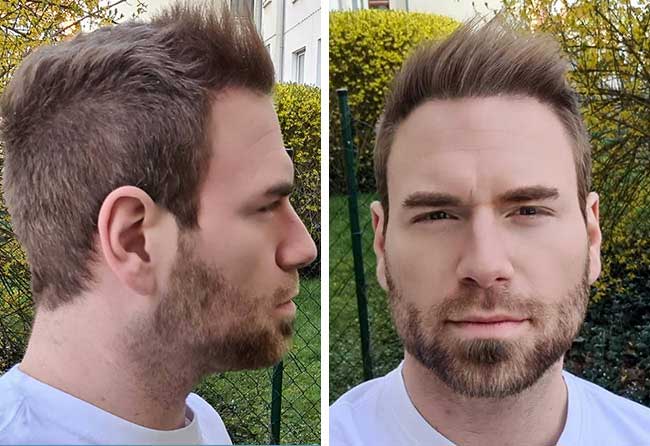 image after hair transplant 4500 grafts kewin lenzing