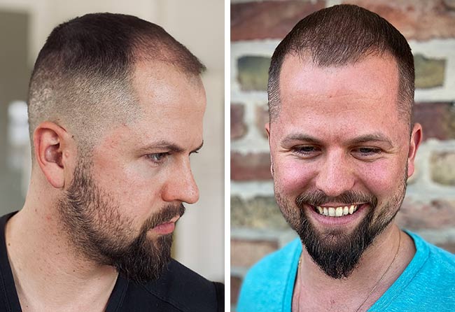 image after hair transplant sapphire 3200 grafts 3 months nico gumlich