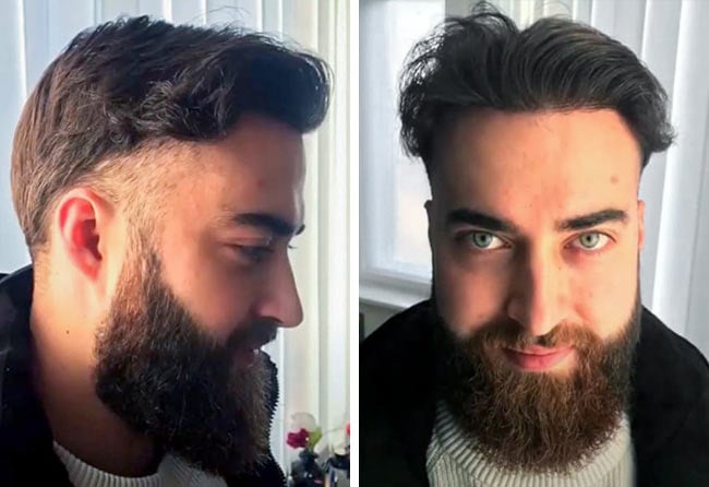 Image before after beard transplant sapphire 4250 grafts 8 month andre ulbrich