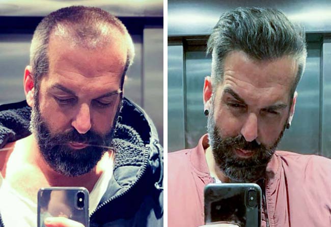 image before after hair transplant sapphire 3400 grafts Juergen T.