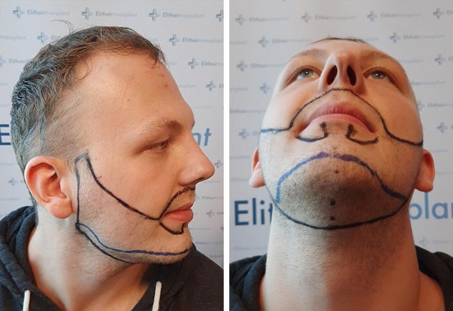Image before beard implant fue sapphire 3250 grafts sascha lockermann
