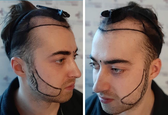 Image before beard transplant sapphire 4250 grafts andre ulbrich