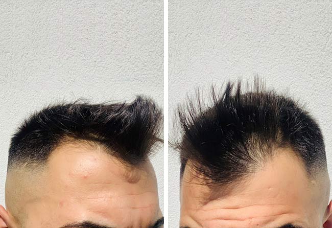 image before hair transplant sapphire 2200 grafts osamani perparim