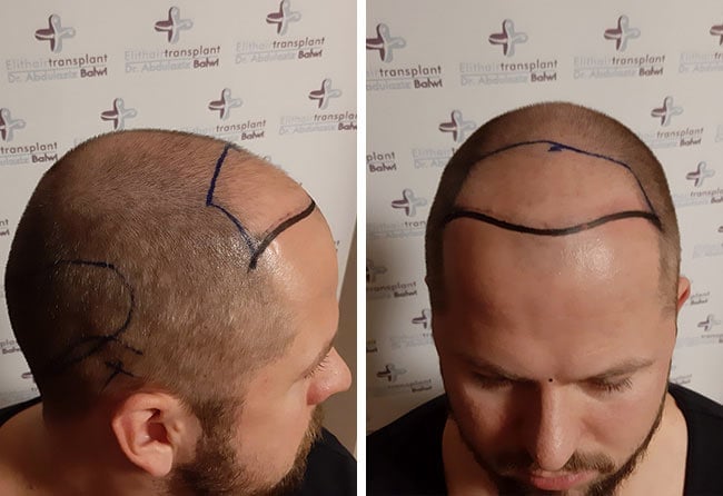 image before hair transplant sapphire 3200 grafts nico gumlich