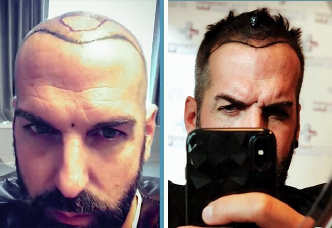 image before hair transplant sapphire 3400 grafts juergen t.