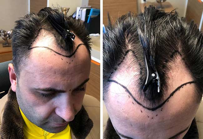 image before hair transplant sapphire 4200 grafts murat kizilkaya