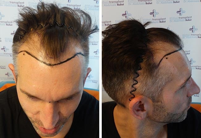 Image before hair transplant sapphire fue 4250 grafts thomas schreier