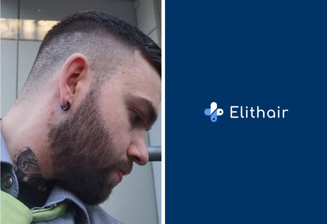 image result beard implant sapphire 2700 grafts nico mueller