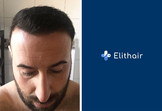 Image result hair transplant fue sapphire 3500 grafts artin asrian