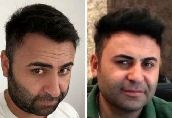Image result hair transplant sapphire 4200 grafts murat kizilkaya