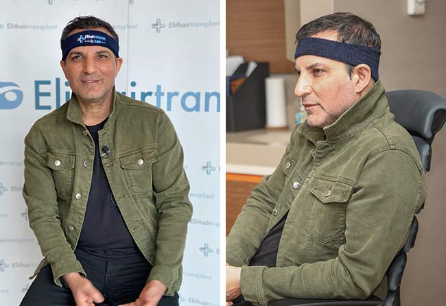 image before DHI hair transplant rafet el roman 2600 grafts