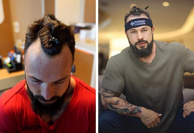 image before hair transplant fue sapphire 2200 grafts road to glory