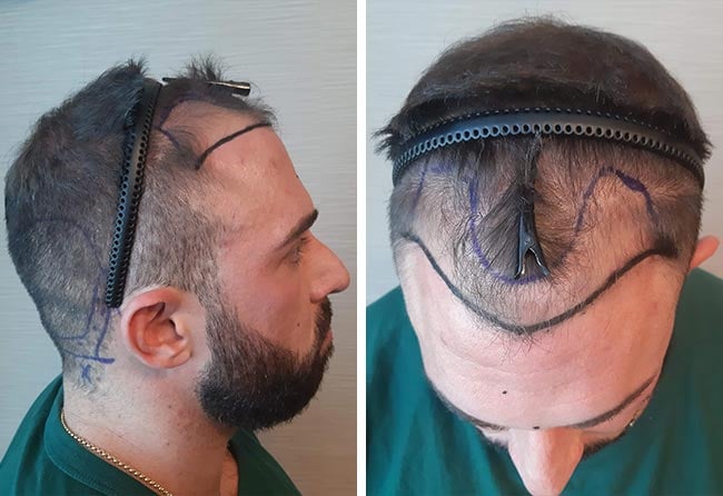 image before hair transplant sapphire 2700 grafts kevin wolter