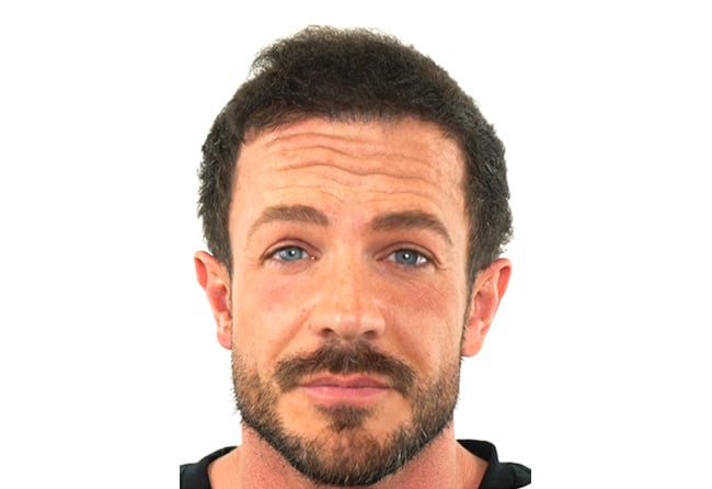Image result hair transplant fue sapphire 3500 grafts simon teichmann