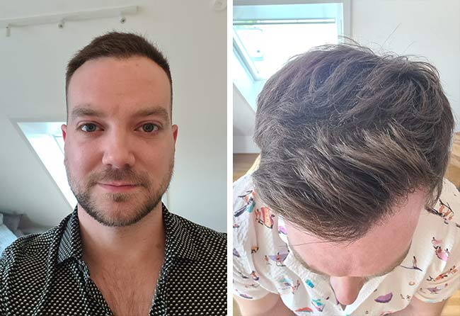 Picture After dhi hair transplantation 2000 grafts Achim Klein after 6 months