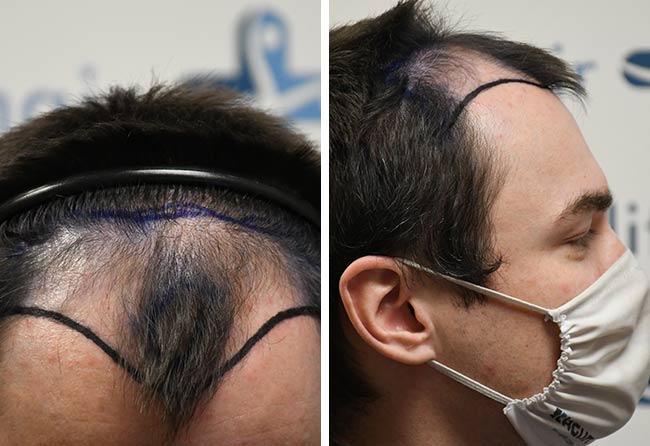 Picture Before dhi hair transplantation 3500 grafts Chris Scholz