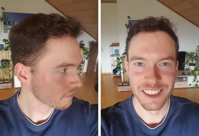 Picture result dhi hair transplantation 3500 grafts Lukas jaeger