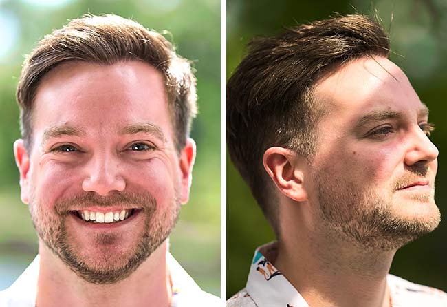 Picture Results dhi hair transplantation 2000 grafts Achim Klein