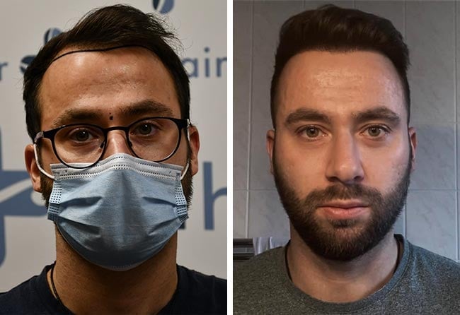 Picture before after dhi hair transplantation 3100 grafts Ricardo Beier