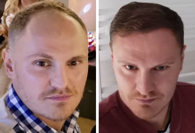 Picture before after dhi hair transplantation 3500 grafts Tim Hoffmann
