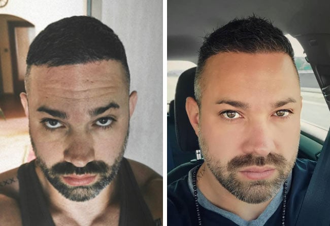 Picture before after dhi hair transplantation 3700 grafts Manuel Anderhuber 6 months