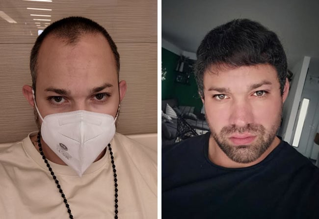 Picture before after dhi hair transplantation 3700 grafts Manuel Anderhuber