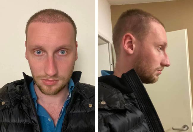 Picture before after dhi hair transplantation 3950 grafts Oliver Dietrich after 2 months