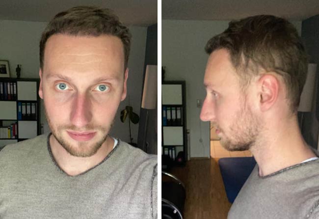 Picture before after dhi hair transplantation 3950 grafts Oliver Dietrich after 4 months