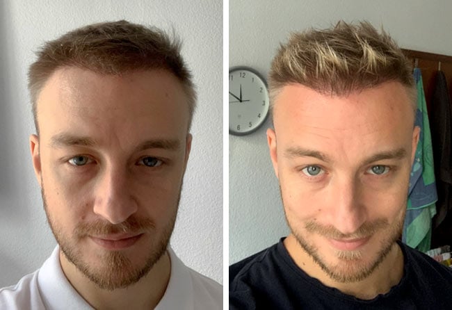 Picture before after dhi hair transplantation 4200 grafts Marius Schmiddi after 6 months