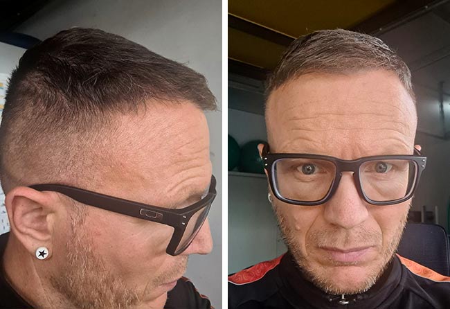 Picture before after dhi hair transplantation 4500 grafts Steffen Kraeuter after 7 months
