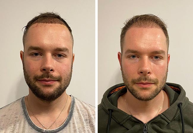 Picture before after dhi hair transplantation 4700 grafts Michael Simma after 3 months