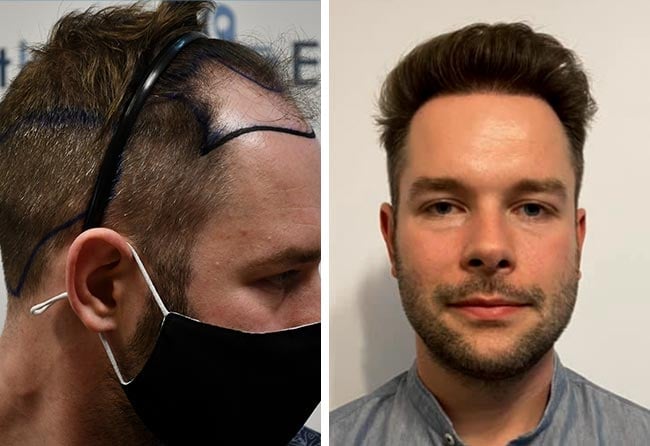 Picture before after dhi hair transplantation 4700 grafts Michael Simma