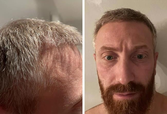 Picture before after dhi hair transplantation 4750 grafts Raffaele Leucci after 3 months