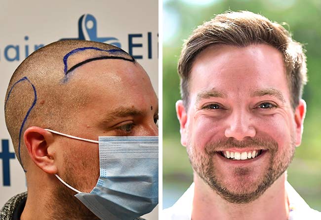 Picture before after hair transplant dhi 2000 grafts Achim Klein